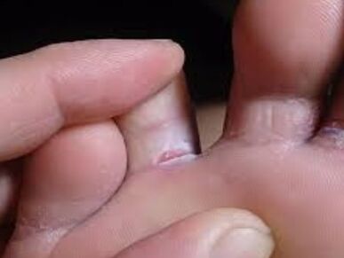 You have a toe fungus