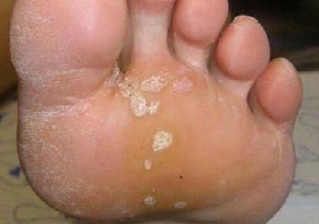 Fungal skin lesions