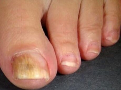 Nail mushroom