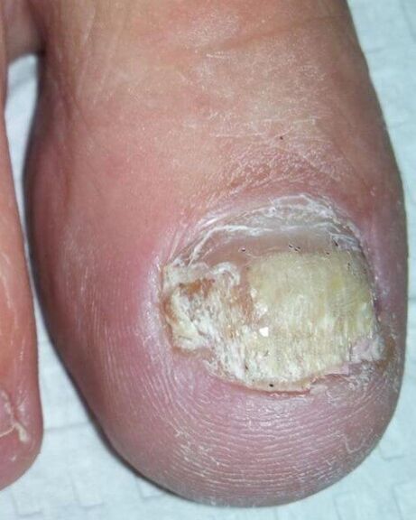The fungus on the legs