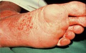 Mushroom at the foot with ulcers