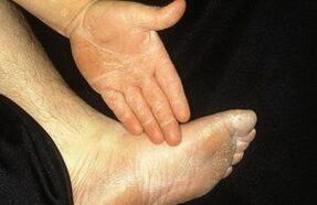 The erased form of mycosis manifests itself by the coat