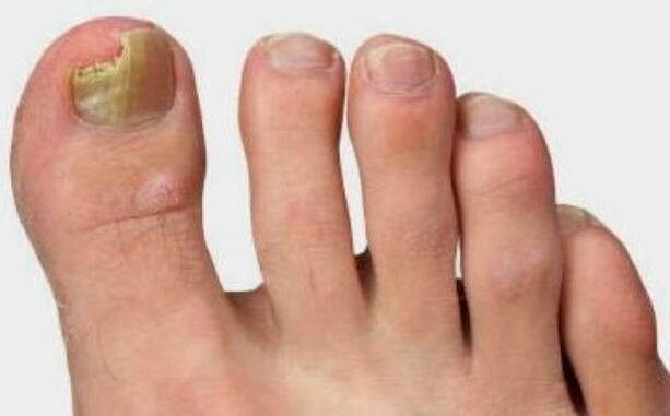 The fungus on the thumb of the leg