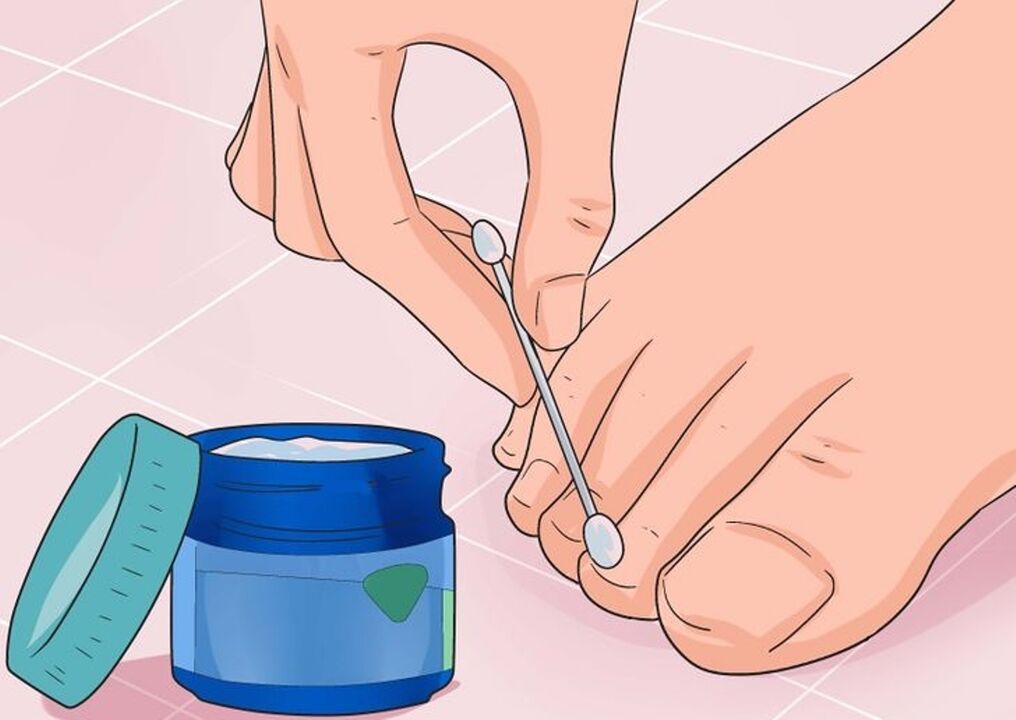 Fungus cure nail