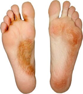 heal the fungus on the finger and not recover it again