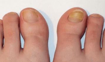 The initial stage of the nail fungus
