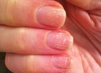The initial step of the fungus on the nails
