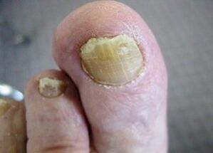 The causes of the mushroom appearance on the nails