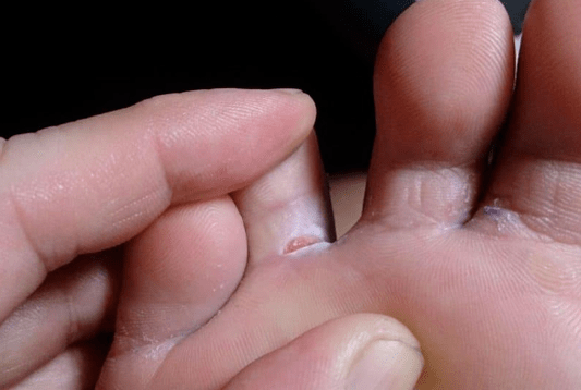 The appearance of bubble training on the feet
