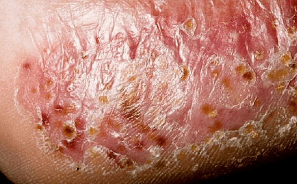 The fungus of the feet