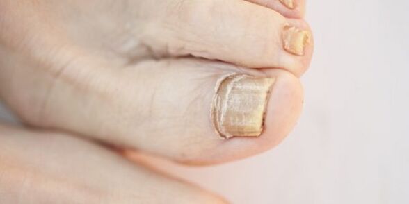 damage to toenail plates due to fungus