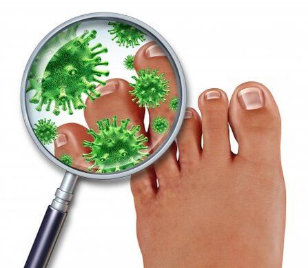 fungal foot infection