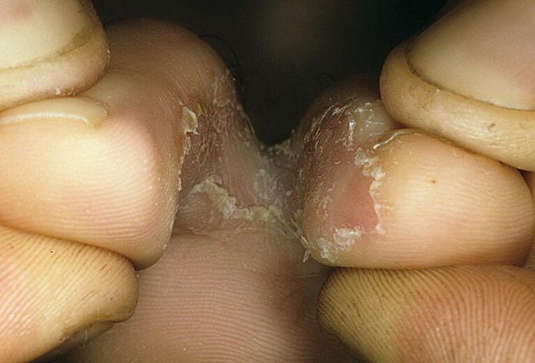 Intriginal form of the fungus
