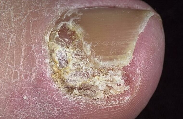Types of onychomycosis