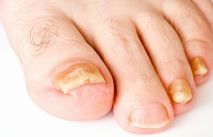 yellow toenail due to fungal infection