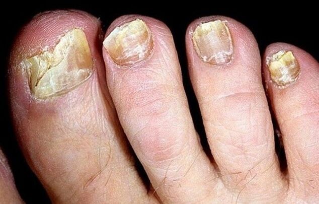 fungus on nails