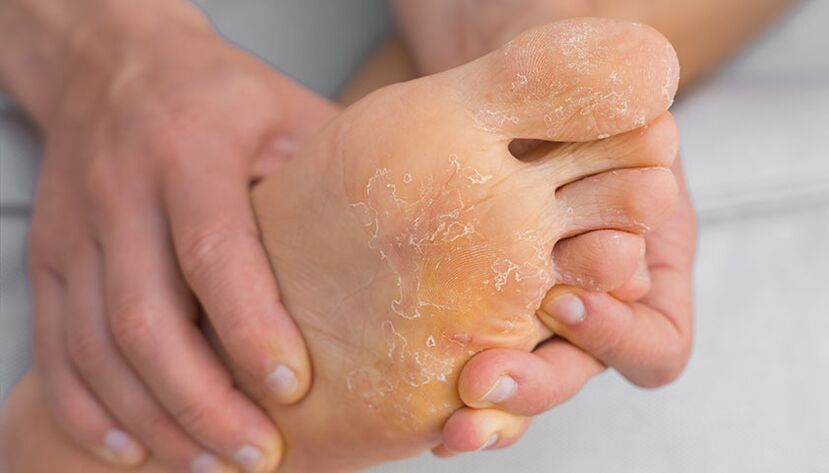 Peeling and itching skin are symptoms of foot fungus